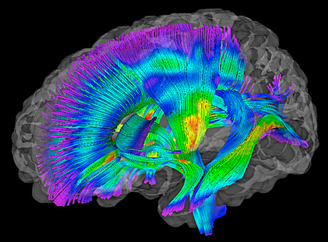 White matter pathways in the brain (warmer colors) depict fractional anisotropy 