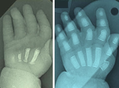 A hand-to-hand comparison of bone formation.