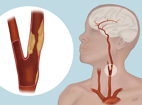 carotid artery blocked arteries neck outlook procedure blockage primary wustl edu disease surgical opens surgery tested open vascular silk medical