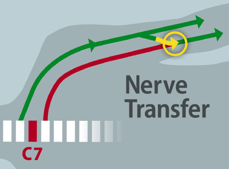 Rerouting nerves to restore partial hand function.