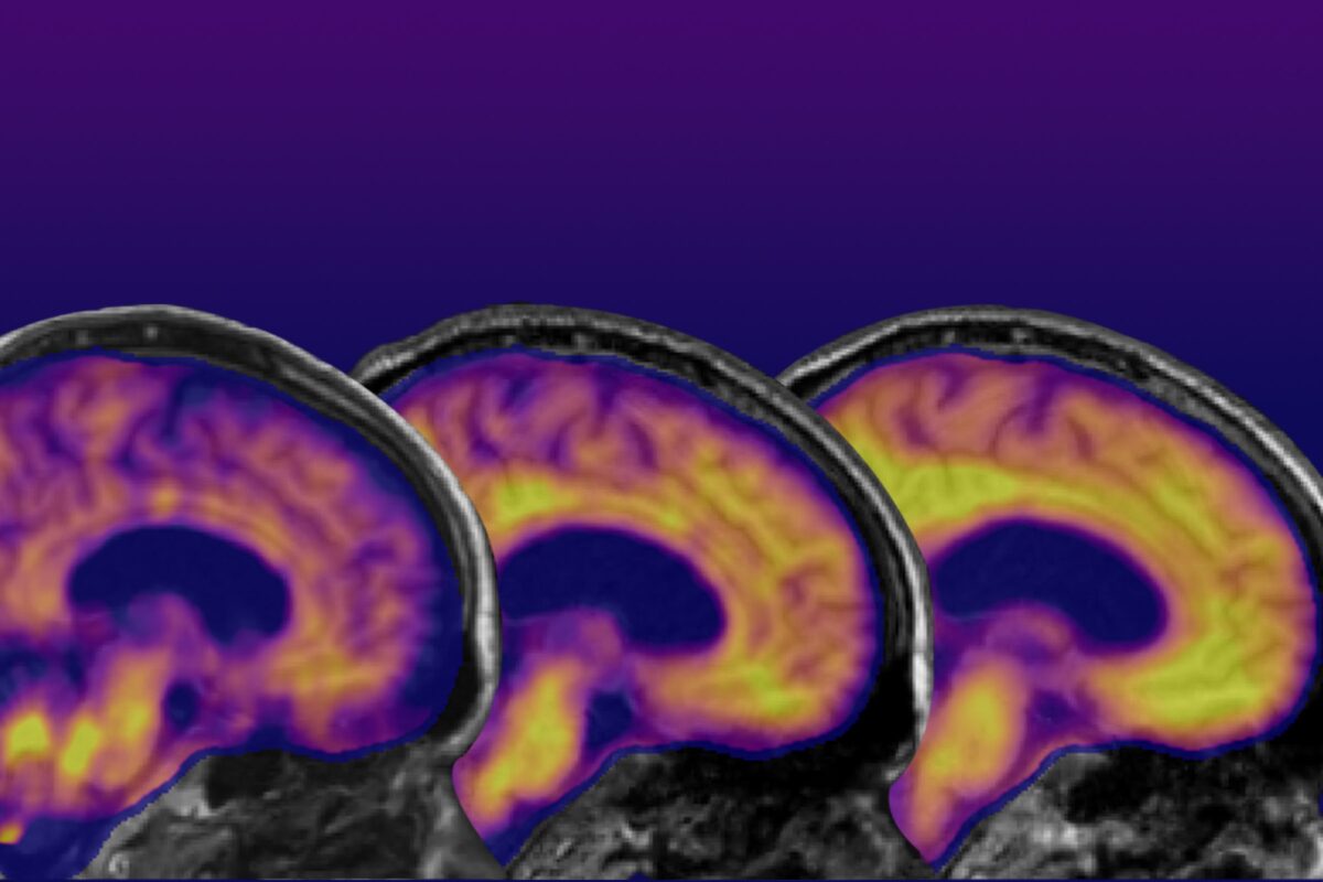 Photo of three different brain scans. 