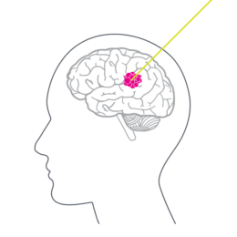 Illustration showing the outline of a head with a focused laser on a highlighted area of the brain.